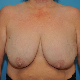 Breast Reduction Bismarck Before & After Gallery – Advanced