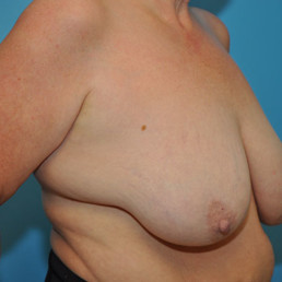 Breast Reduction Bismarck Before & After Gallery – Advanced