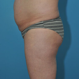 Plastic Surgery Case Study - Full Tummy Tuck and Flank Liposuction Before  Weight Loss - Explore Plastic Surgery