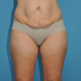 Before & After a Plus Size Tummy Tuck (Dr. Repta) 